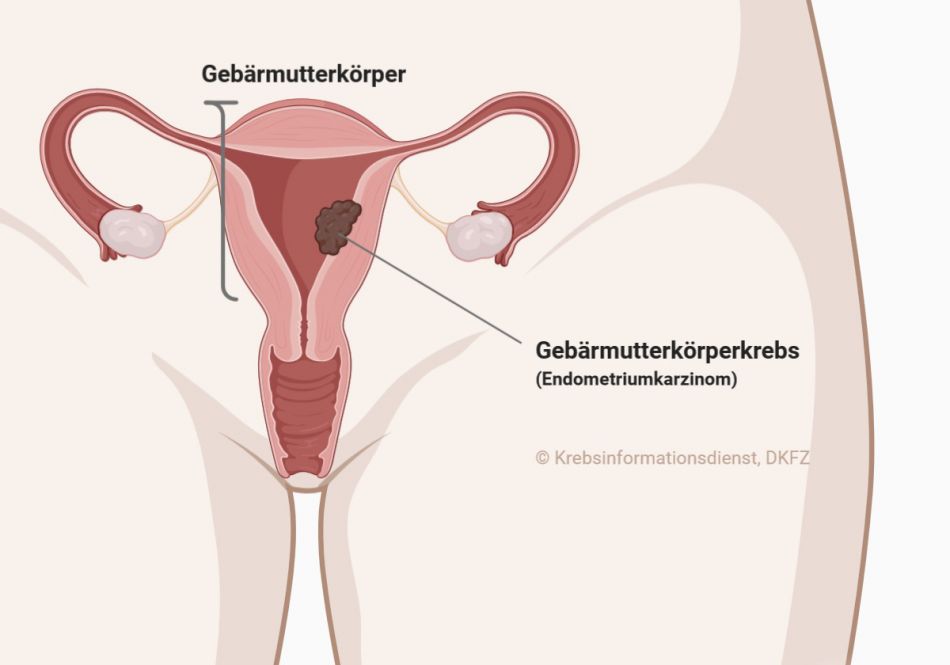 Beschriftete anatomische Darstellung eines Endometriumkarzinoms 