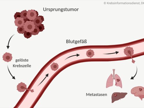 Vom Ursprungstumor lösen sich Krebszellen ab und gelangen über die Blutbahn in andere Organe. Dort bilden sie Metastasen.