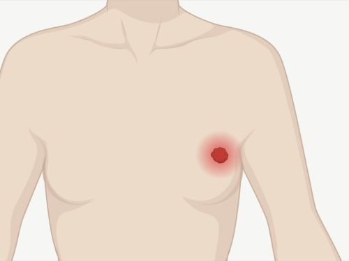 Grafische Darstellung eines Tumor in der weiblichen Brust, der rot hinterlegt ist.