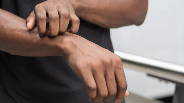 Juckreiz, © 9nong, Shutterstock.com Eine Hand kratzt die Haut am Unterarm wegen Hautjucken