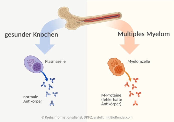 Multiples Myelom, © Krebsinformationsdienst, DKFZ, erstellt mit BioRender.com Schematische Darstellung eines Knochen mit Knochenmark, gesunder Plasmazellen und Myelomzellen.