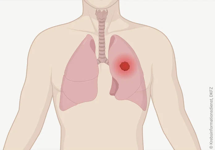 Tumor in der Lunge, © Krebsinformationsdienst, DKFZ; erstellt mit BioRender.com Grafik eines menschlichen Oberkörpers mit Lunge und Luftröhre. Ein Tumor in der Lunge ist als leuchtender Punkt dargestellt.