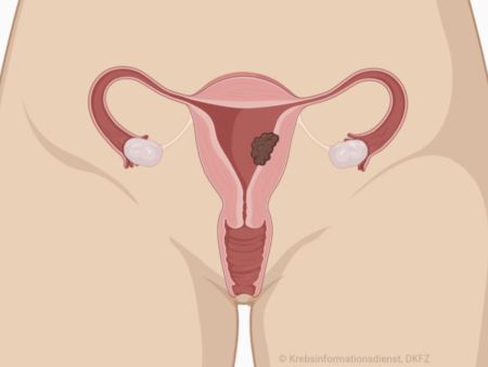 Die Grafik zeigt die Anatomie der weiblichen Geschechtsorgane mit Scheide, Gebärmutterhals, Gebärmutterkörper, zwei Eileitern und Eierstöcken. Im Gebärmutterkörper ist ein Tumor dargestellt.