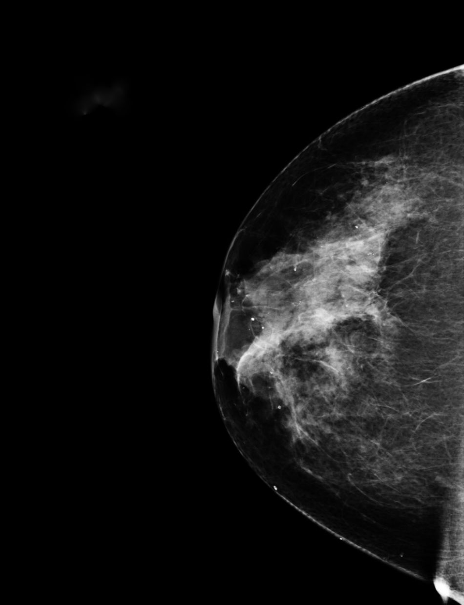 schwarz-weiße Röntgenaufnahme einer weiblichen Brust