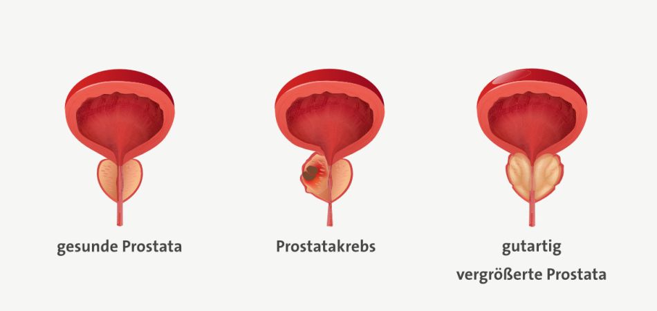 Infografik einer gesunden Prostata (links) im Vergleich zu einer Prostata mit einem bösartigen Tumor (mittig) und einer gutartig vergrößerten Prostata (rechts). 