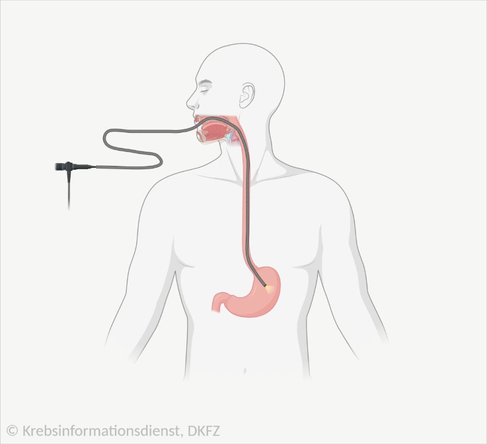 Schematische Darstellung, wie der Schlauch bei einer Magenspiegelung durch die Speiseröhre bis in den Magen verläuft.