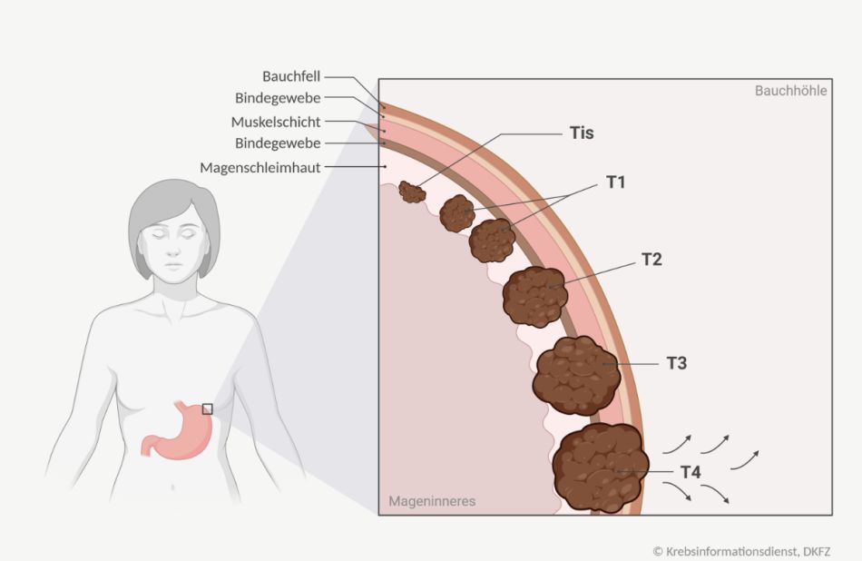 Grafik eines vergrößerten Abschnitts der Magenwand bestehend aus Magenschleimhaut, Bindegewebeschicht, Muskelschicht und einer zweiten Bindegewebeschicht (von innen nach außen gesehen). Eingezeichnet sind die Tumorstadien Tis-T4.
