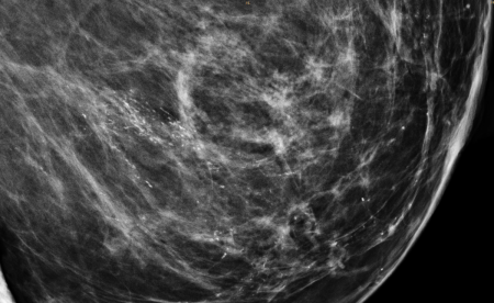 Schwarz-weißes Röntgenbild einer weiblichen Brust mit weißlich sichtbaren Kalkeinlagerungen.
