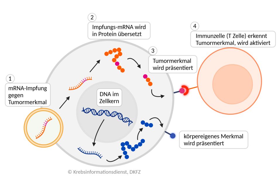 Ablauf einer mRNA-Impfung: 1. mRNA, die den Bauplan für Tumormerkmale enthält, gelangt über Lipidpartikel (Fett-Tröpfchen) direkt in Körperzellen. 2. Entsprechend des Bauplans werden Proteine gebildet und  3. Abschnitte als Neoantigene an der Zelloberfläche präsentiert.  4. Immunzellen erkennen das fremde Neoantigen und werden in Alarmbereitschaft gegen das Tumormerkmal versetzt.