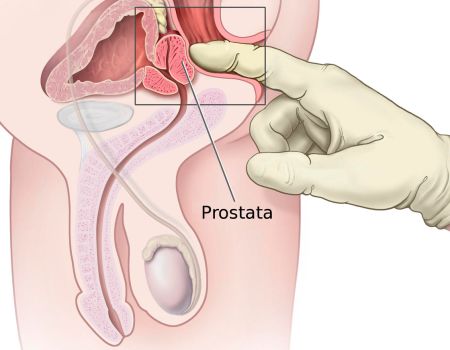 Der Arzt oder die Ärztin tastet die Prostata über den Enddarm (Rektum) ab.