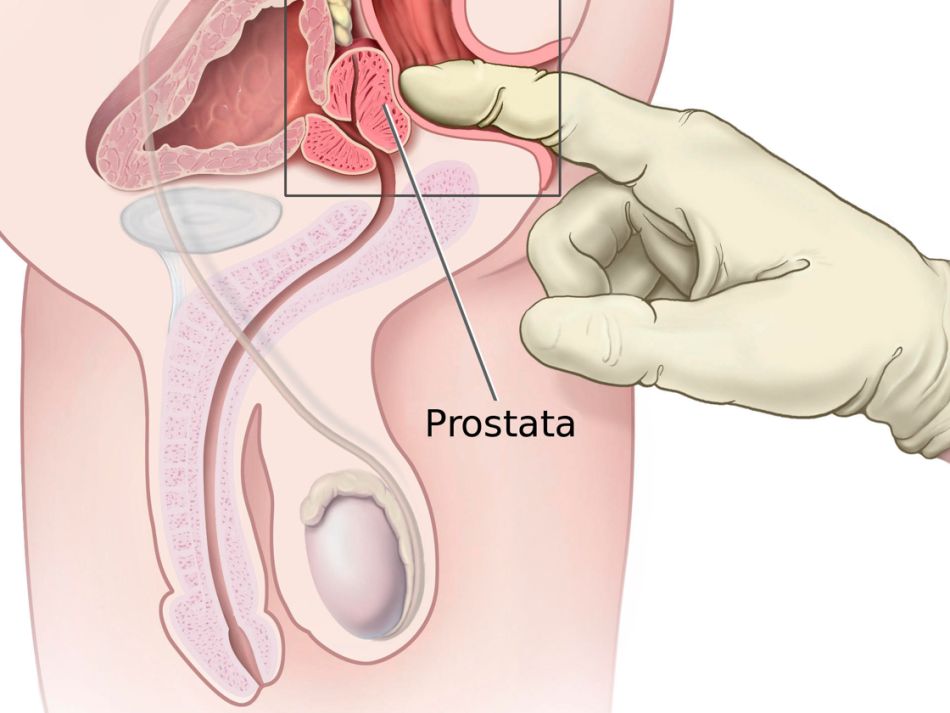 Der Arzt oder die Ärztin tastet die Prostata über den Enddarm (Rektum) ab.