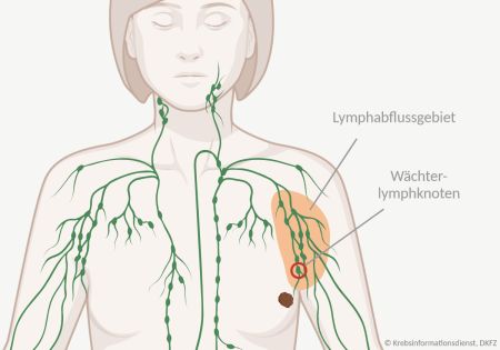 Infografik, die einen weiblichen Oberkörper mit einem Tumor in der linken Brust zeigt; das Gebiet, in das die Gewebsflüssigkeit des Tumors abfließt, ist markiert und der Wächterlymphknoten ist umkreist.