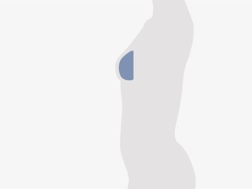 Grafische Darstellung eines menschlichen Oberkörpers, blau eingefärbt ist die Brust.
