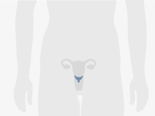 Grafische Darstellung eines menschlichen Oberkörpers, blau eingefärbt ist der Gebärmutterhals.