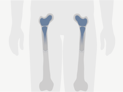 Oberschenkelknochen mit hevorgehobenem Knochenmark