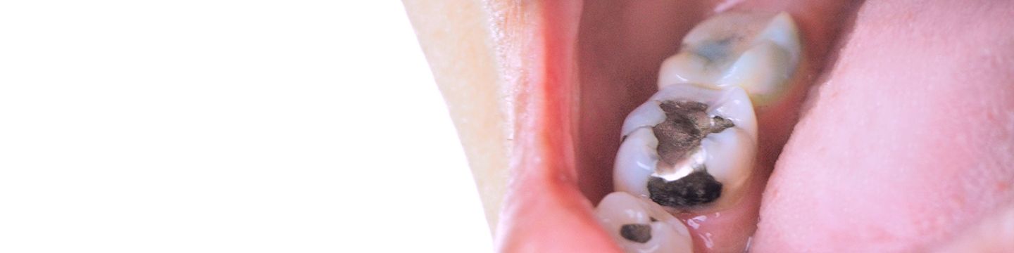 Offener Mund mit Zahnfüllung aus Amalgam ©  TANAPAT LEK.JIW, Shutterstock