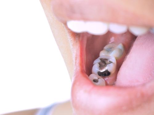 Offener Mund mit Zahnfüllung aus Amalgam ©  TANAPAT LEK.JIW, Shutterstock