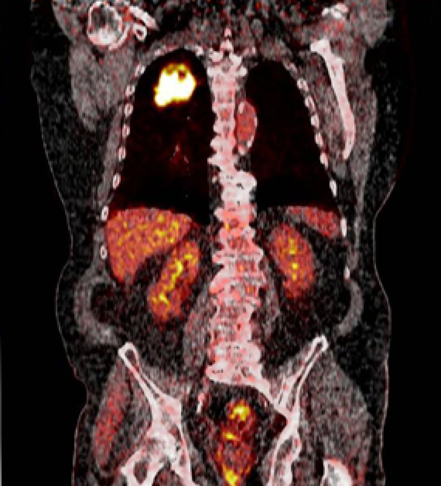 PET/CT-Aufnahme eines Lungentumors © Molecular Imaging/DKFZ 
