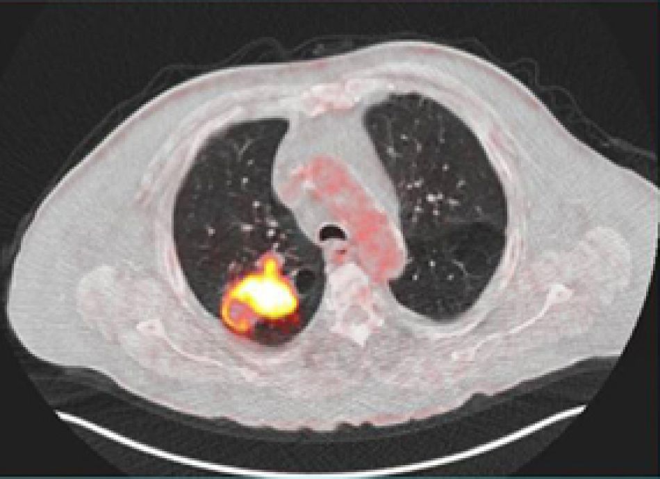 PET/CT-Aufnahme eines Lungenkarzinoms © Molecular Imaging/DKFZ 