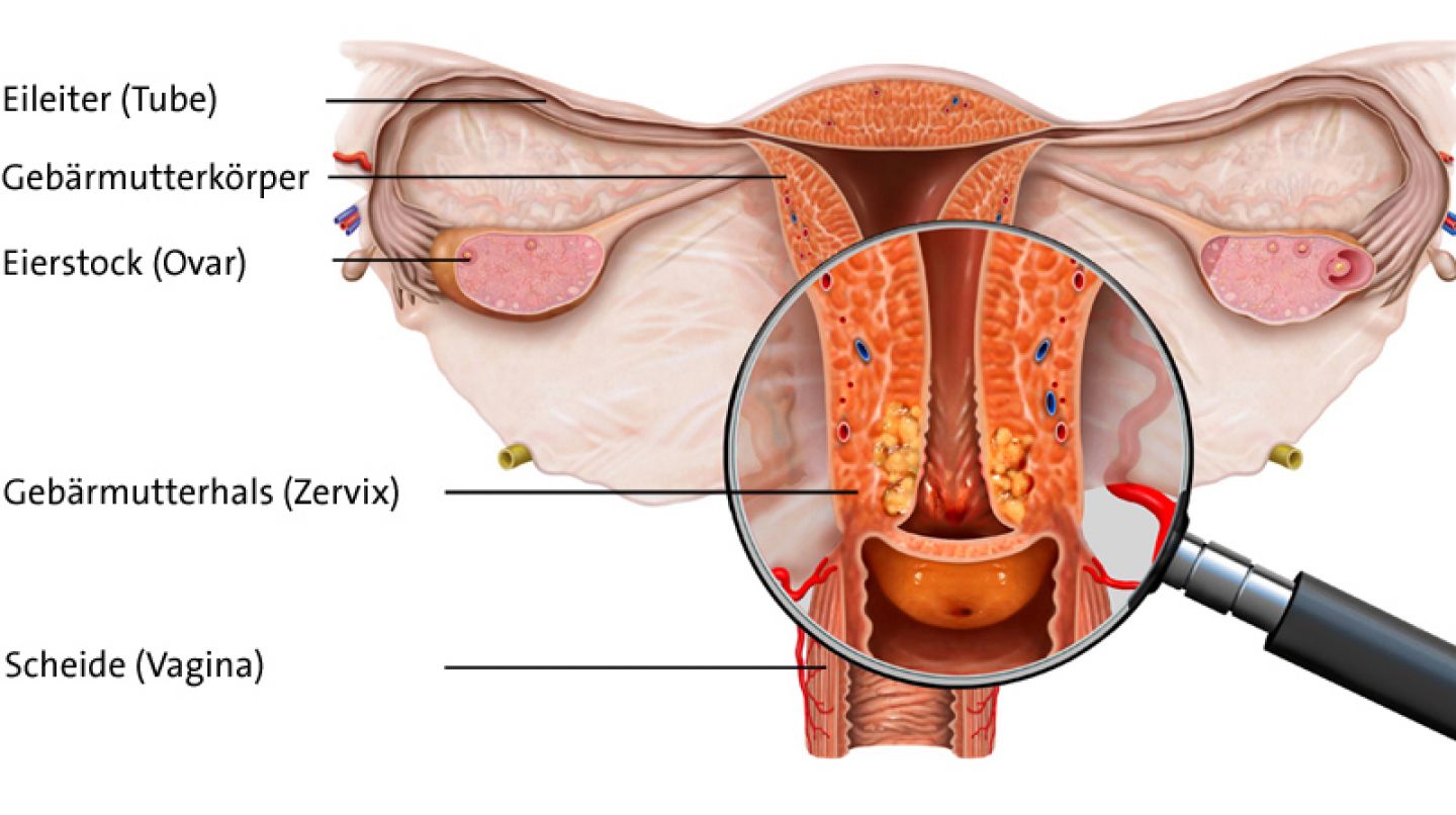 hpv gebarmutter entfernen cum se tratează papiloamele uterului