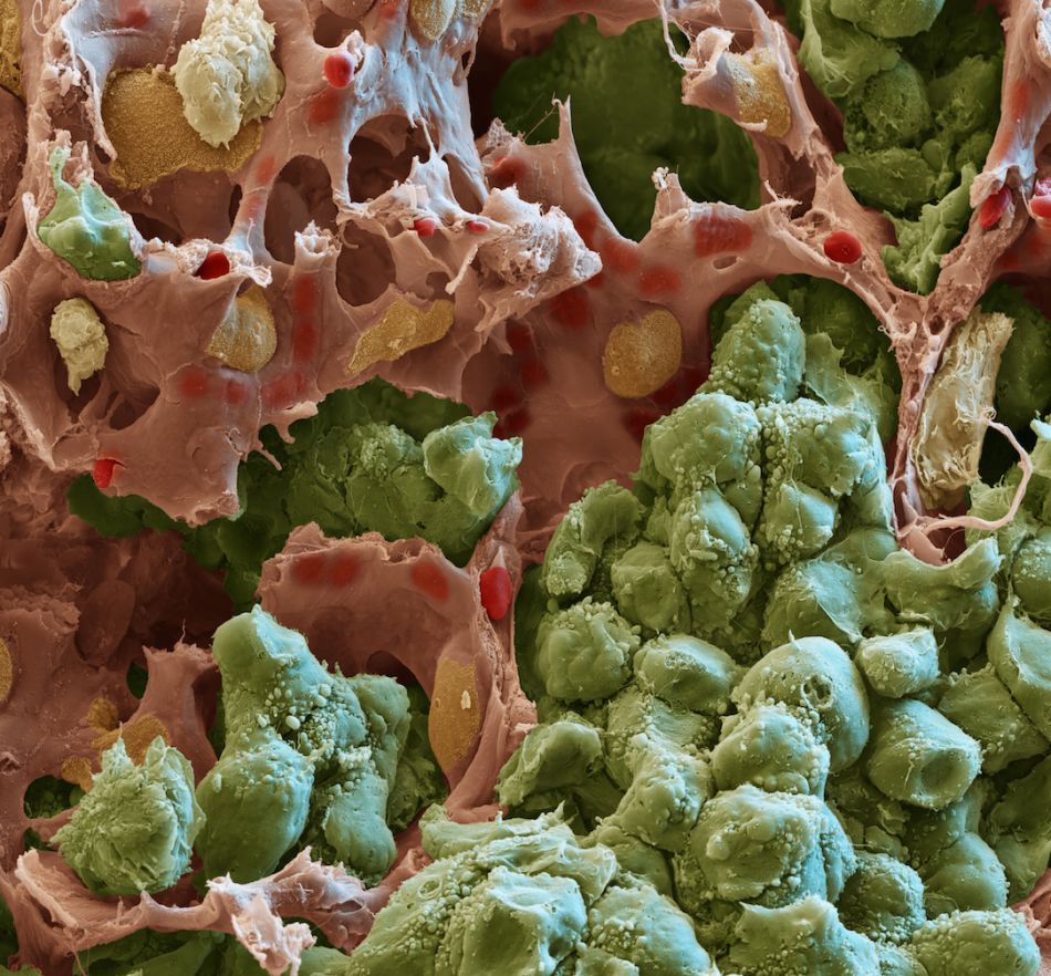Rasterelektronenmikroskopische Aufnahme einer Lungenmetastase  © Oliver Meckes, Eye of Science / Hellmut Augustin, DKFZ