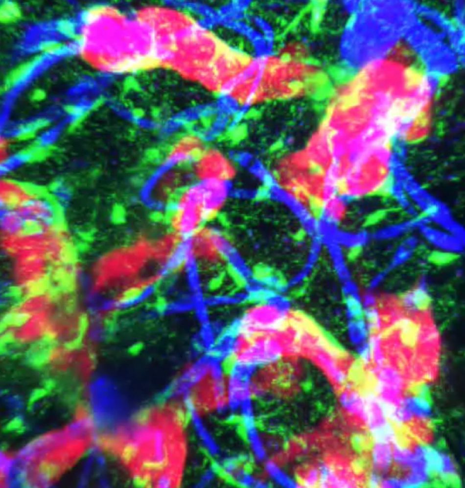 Mikroskopische Aufnahme einer wachsenden Metastase (rot) im Gehirn (Blutgefäße: blau). Bestimmte Immunzellen des Gehirns (grün) greifen die Tumorzellen während des Wachstums an © Anna Berghoff, DKFZ