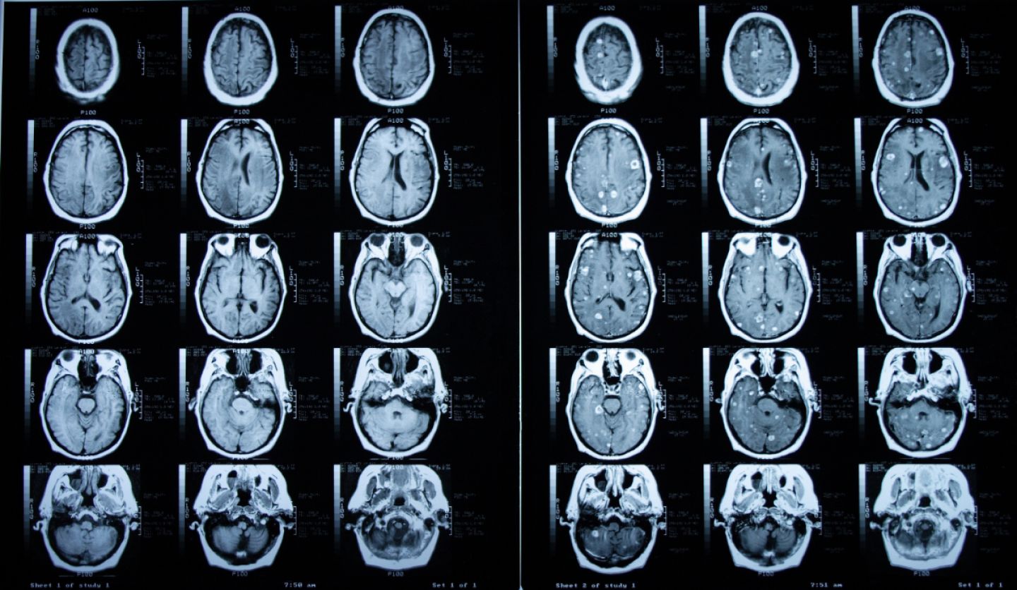 Aufnahme einer Magnetresonanztomographie (MRT) des Gehirns ohne (links) und mit (rechts) Kontrastmittel.