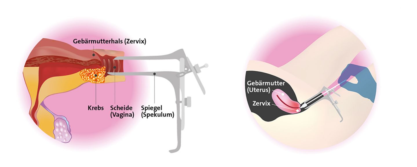 Mithilfe eines Spiegels (Spekulum) können Frauenärzte Zellmaterial am Muttermund und Gebärmutterhalskanal mit einem Spatel entnehmen. © modifiziert nach Studio BKK/shutterstock.com