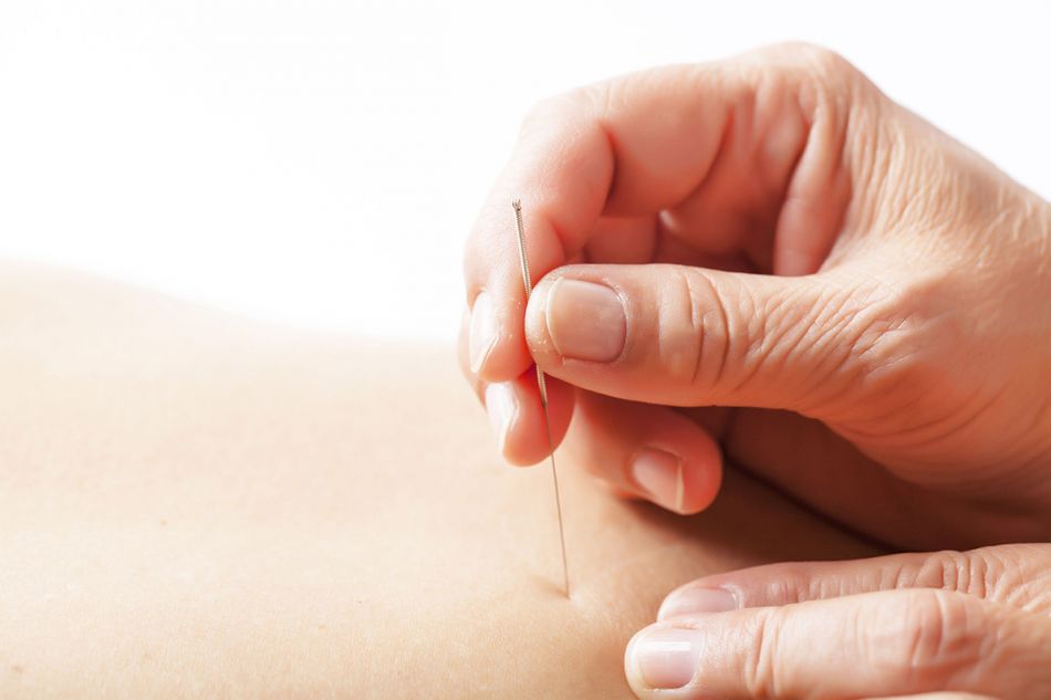 Hand sticht Akupunkturnadel in Haut © maoyunping, Shutterstock