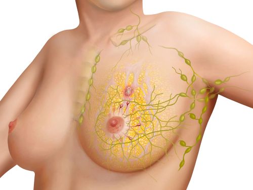 Graphische Darstellung einer weiblichen Brust mit Lymphsystem und Lymphknoten © Frank Geisler, MediDesign