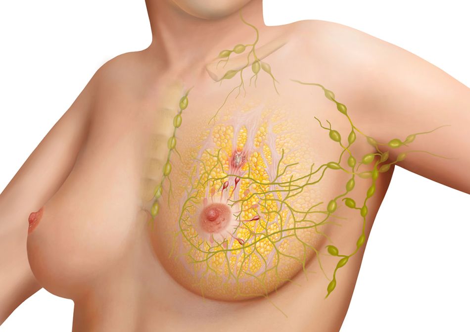 Graphische Darstellung einer weiblichen Brust mit Lymphsystem und Lymphknoten. © Frank Geisler, MediDesign