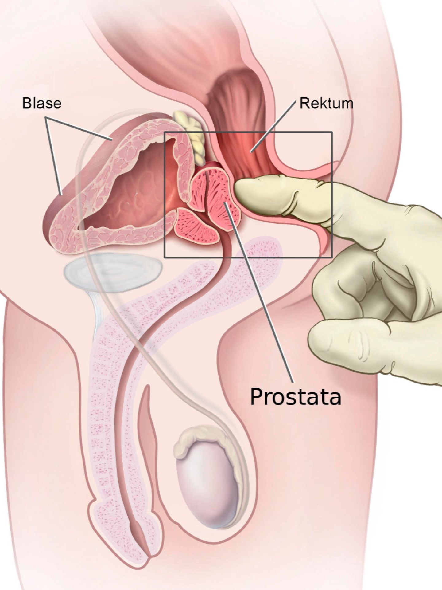 Anatomische Darstellung, wie der Finger eines Arztes die Prostata über den Enddarm (Rektum) abtastet.