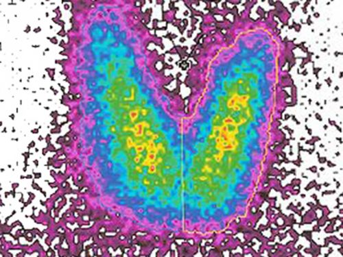 Aufnahme einer nuklearmedizinischen Untersuchung der Schilddrüse (Szintigrafie), um Stoffwechselvorgänge sichtbar zu machen. © Bionerd, commons.wikimedia.org
