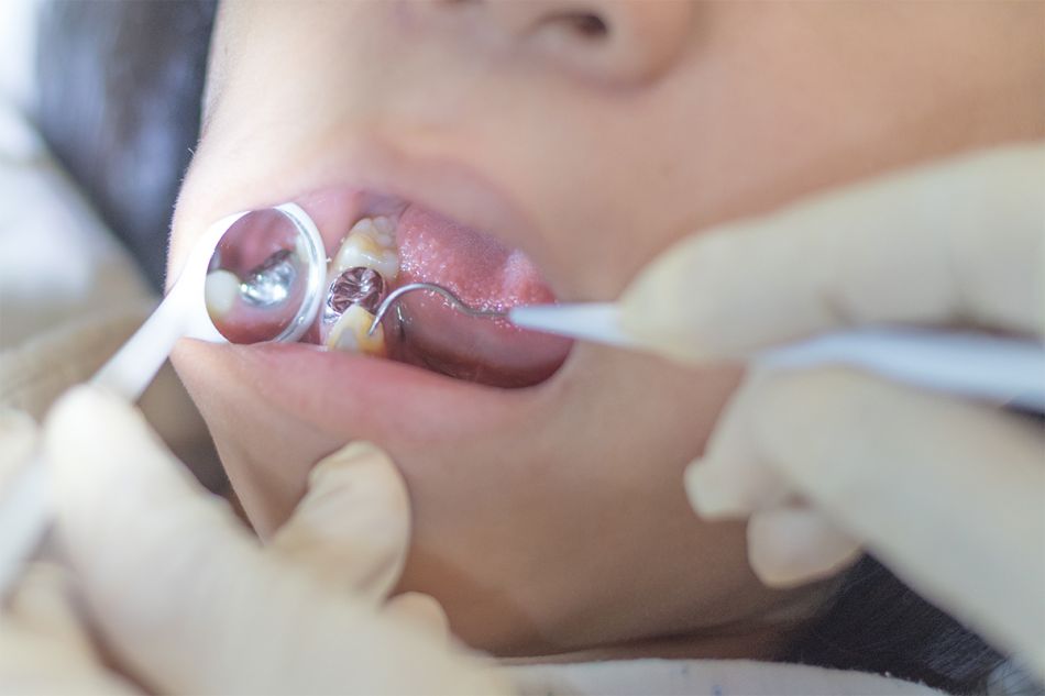 Zahnarzt untersucht die Amalgamfüllung einer Patientin mit einem Mundspiegel.