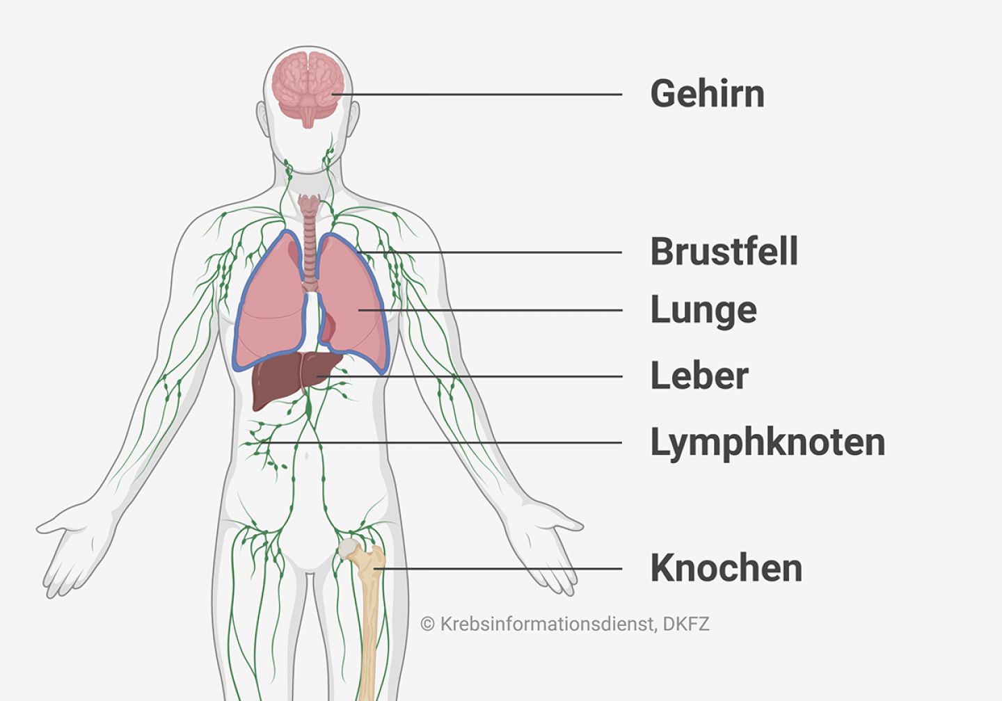Anatomische Abbildung, die zeigt wo sich beim CUP-Syndrom häufig Metastasen bilden: im Gehirn, Brustfell, Lunge, Leber, Lymphknoten und Knochen.