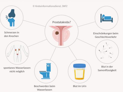Mindmap möglicher Symptome bei Prostatakrebs: Knochenschmerzen, Blut in Urin oder Samenflüssigkeit, Einschränkung bei Geschlechtsverkehr, Probleme beim Wasserlassen.