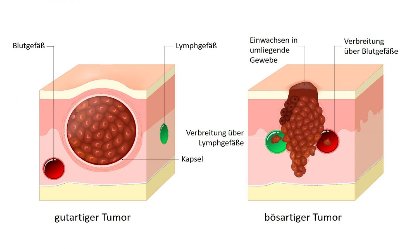 Ein gutartiger Tumor bildet einen abgeschlossenen Gewebeverband. Ein bösartiger Tumor wächst in andere Gewebe ein und kann sich über Blut- und Lymphbahnen ausbreiten.