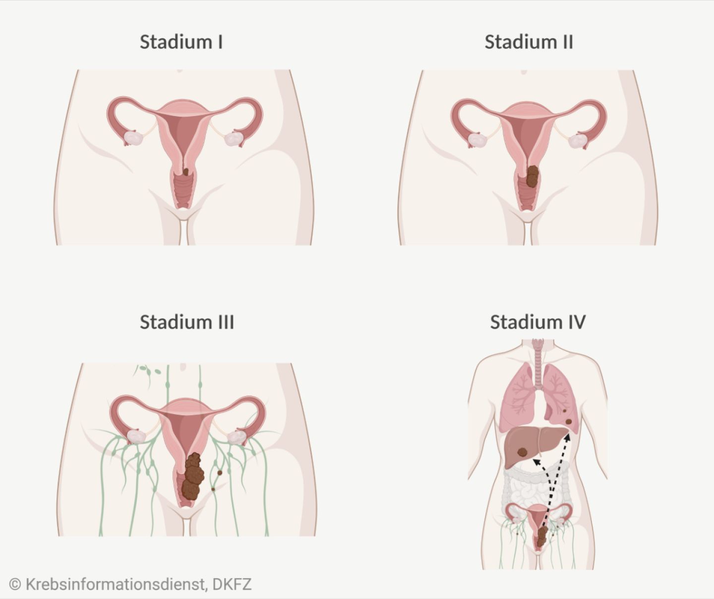 In Stadium 1 ist der Tumor auf den Gebärmutterhals beschränkt, in Stadium 2 wächst er darüber hinaus, in Stadium 3 wächst der Tumor bis zur Beckenwand oder ins untere Drittel der Scheide, in Stadium 4 wächst er in den Bauchraum oder bildet Fernmetastasen.