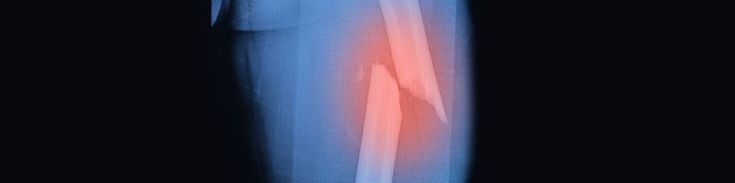 Röntgenbild mit gebrochenem Oberschenkelknochen