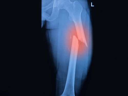 Röntgenbild mit gebrochenem Oberschenkelknochen