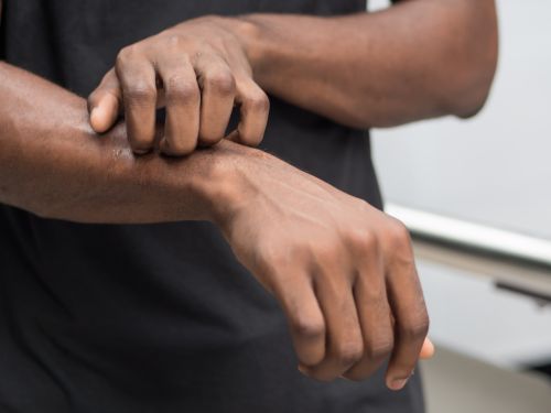 Eine Hand kratzt die Haut am Unterarm wegen Hautjucken