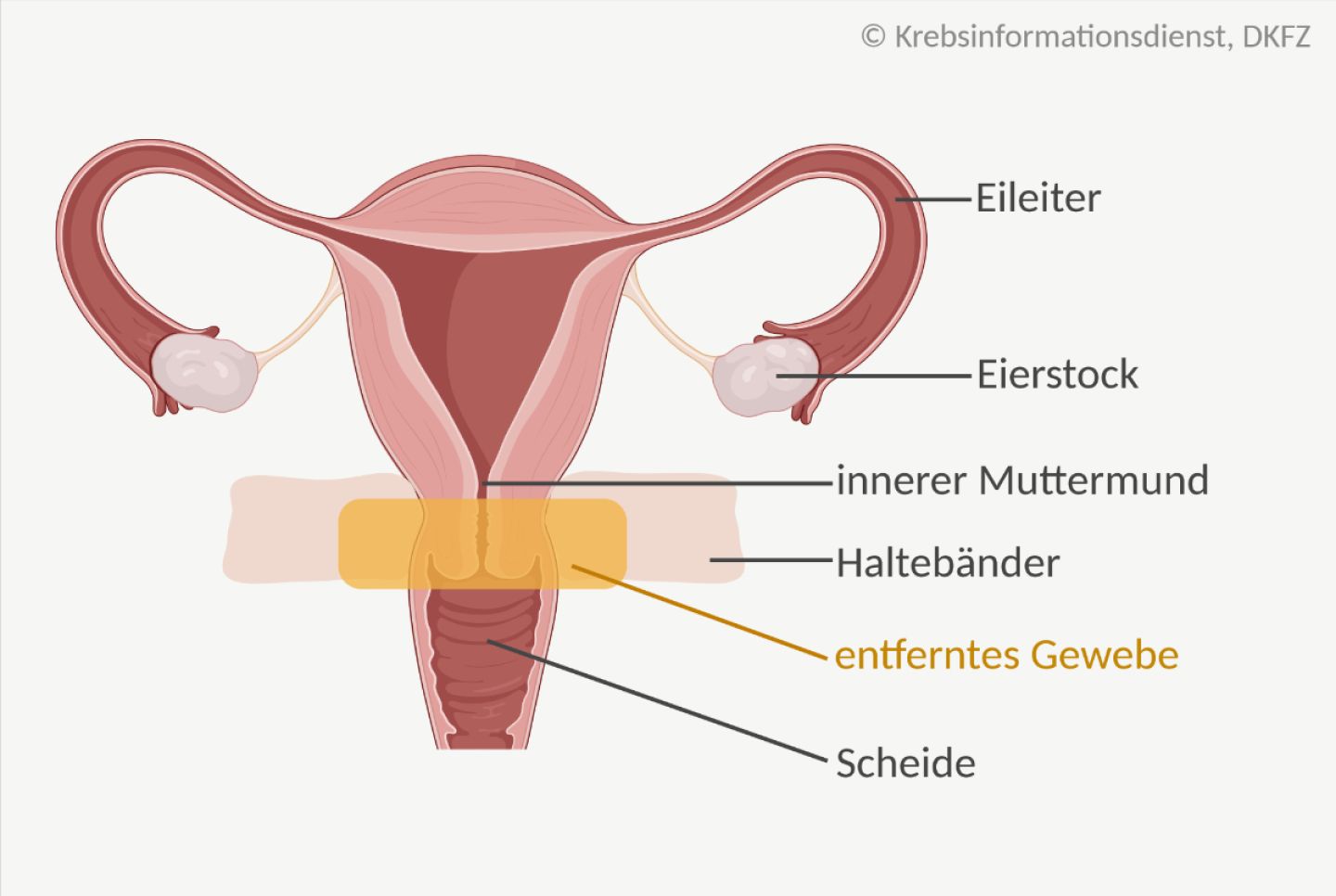Anatomische Darstellung der Gebärmutter mit den Geweben, die bei der Trachelektomie herausoperiert werden.