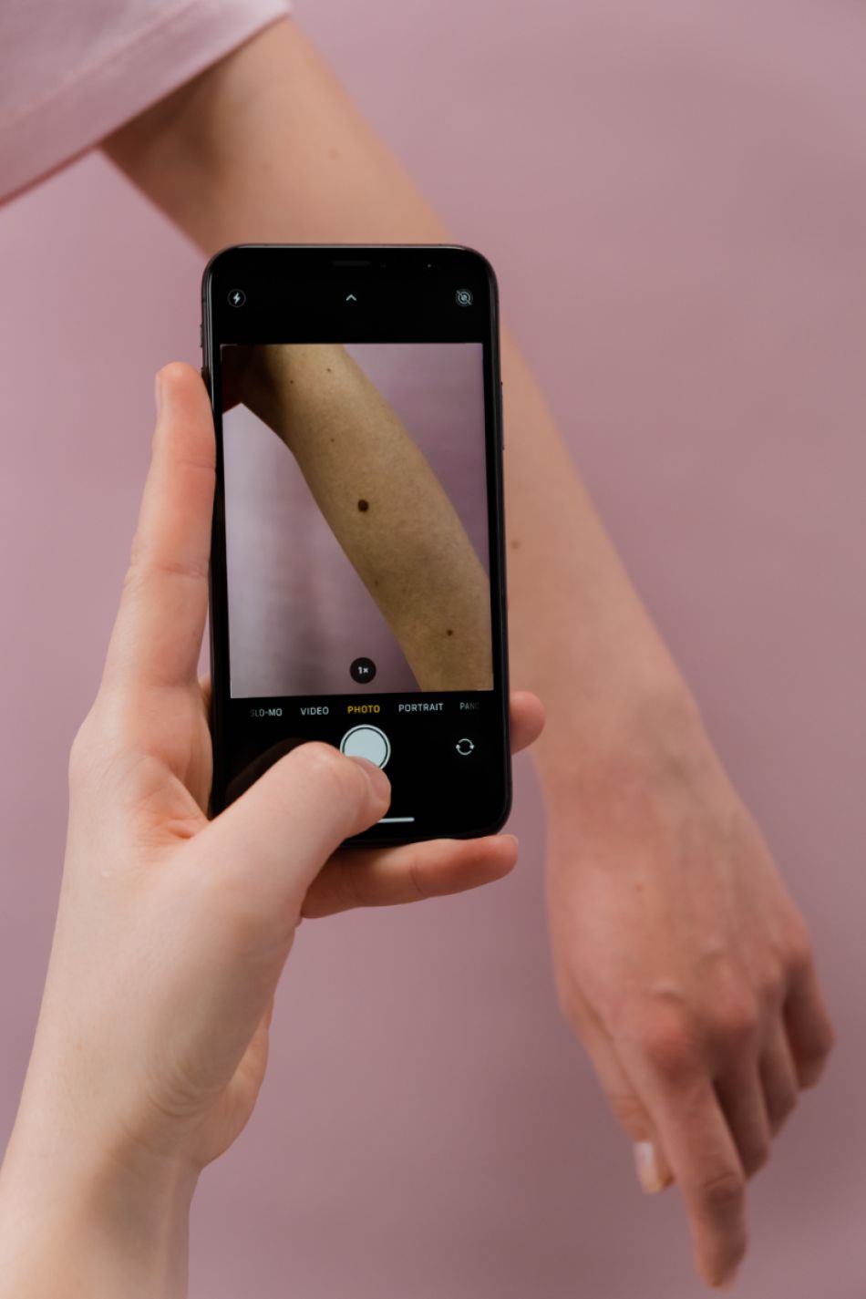 Eine Hand hält ein Handy, um damit ein Bild von einem Pigmentfleck auf dem Arm zu machen.