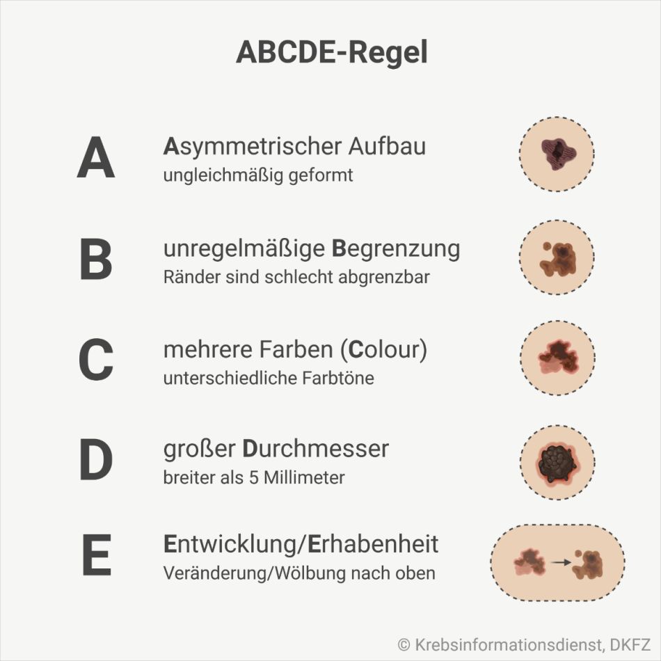 Eine Grafik zeigt die ABCDE-Regel: A steht für einen asymmetrischen Aufbau, B für eine unregelmäßige Begrenzung, C für Colour – verschiedene Farben, D für einen großen Durchmesser und E für Erhabenheit oder Entwicklung.