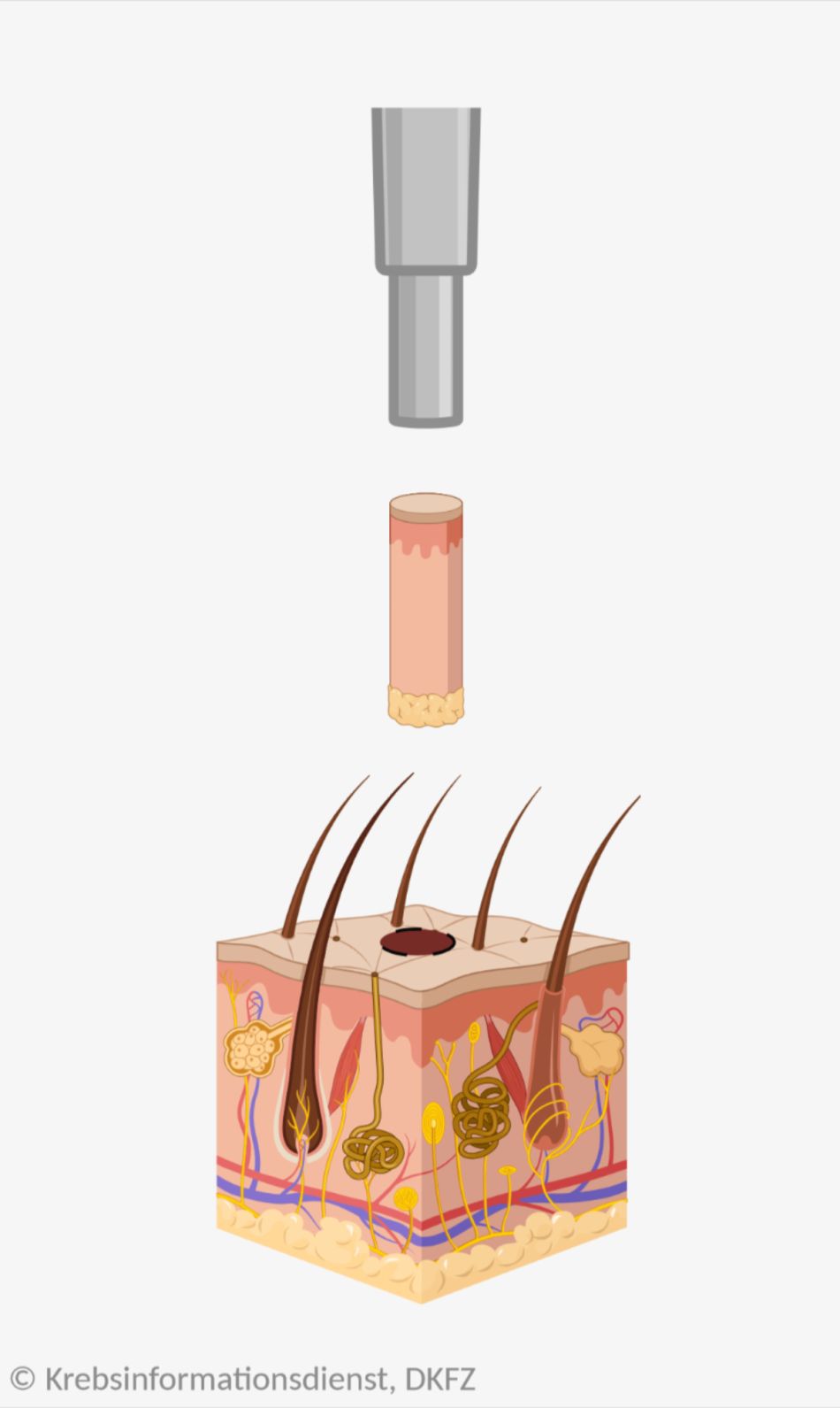 Bei einer Stanzbiopsie der Haut wird mit einer Hohlnadel eine zylinderförmige Probe aus dem Gewebe ausgestanzt.