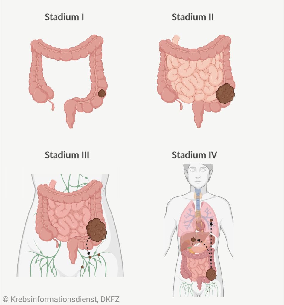 Stadieneinteilung bei Darmkrebs: Stadium I: Tumor auf den Darm begrenzt, Stadium II: Ausbreitung in umliegende Organe, Stadium III: Ausbreitung in Lymphknoten, Stadium IV: Fernmetastasen