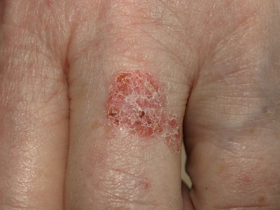 Eine fleckenförmige, gerötete, schuppige Hautveränderung (Morbus Bowen) auf dem Finger einer Hand.