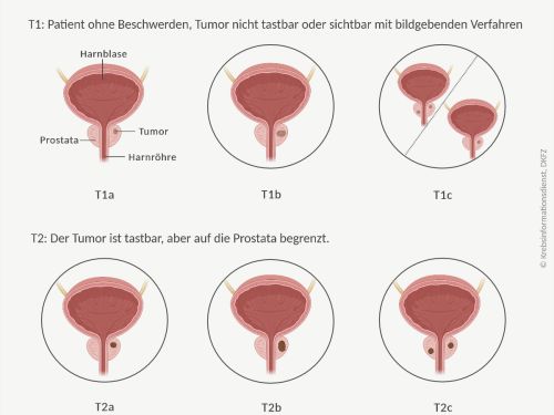 Grafische Darstellung der 6 Tumorstadien bei lokal begrenztem Prostatakrebs.
