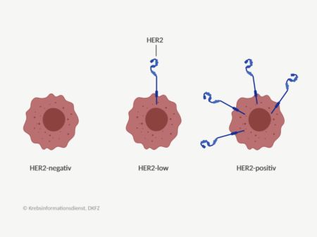 In der Grafik sind drei Krebszellen mit keinem, wenig und viel HER2 auf der Zelloberfläche abgebildet. Die Krebszelle mit wenig HER2 wird als HER2-low bezeichnet.