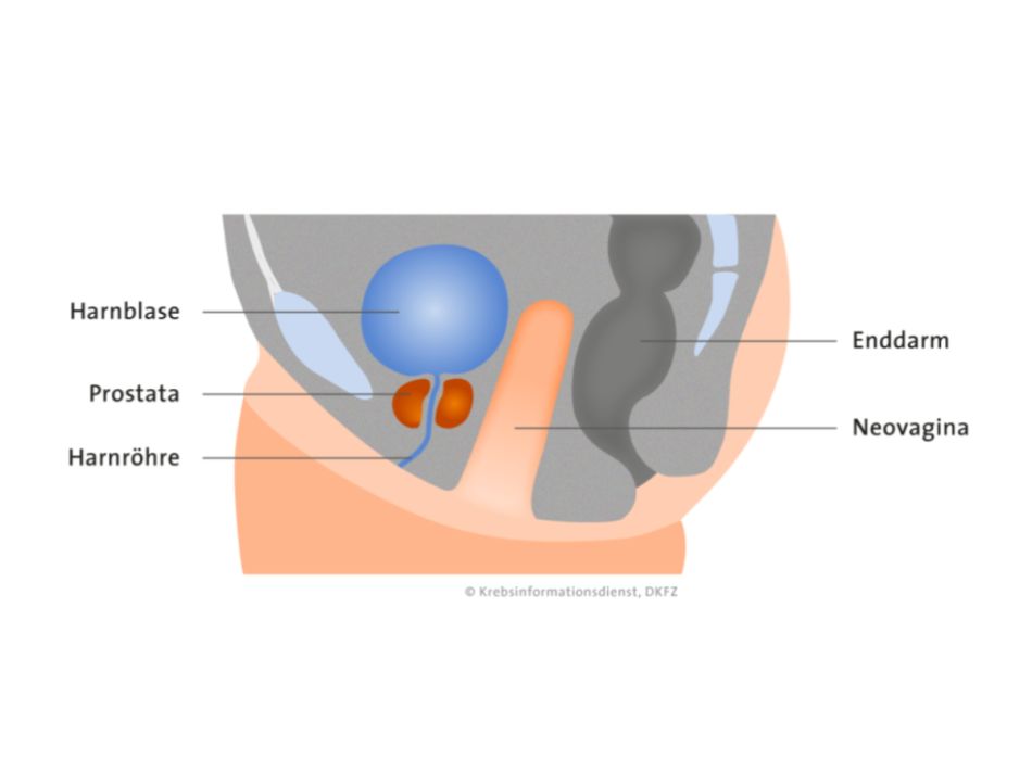 Grafik zur Anatomie der Beckenorgane bei der Transfrau, wenn sie geschlechtsangleichend operiert wurde, Längsschnitt: Die Neovagina liegt in der Mitte und grenzt nach vorne an Harnblase und Prostata sowie nach hinten an den Enddarm.